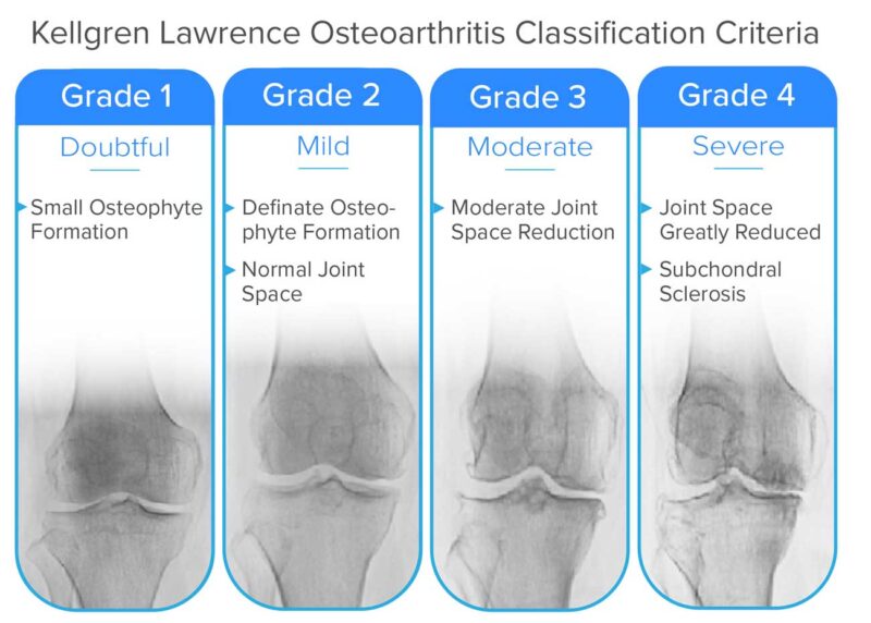 Knee Osteoarthritis Peak Sport And Spine Centre